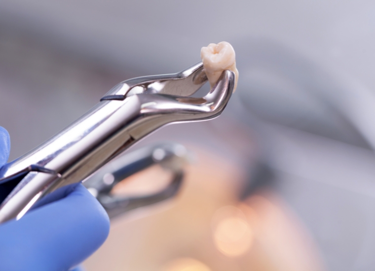 Tooth Extractions